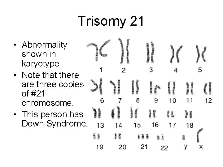 Trisomy 21 • Abnormality shown in karyotype • Note that there are three copies Trisomy 21 • Abnormality shown in karyotype • Note that there are three copies