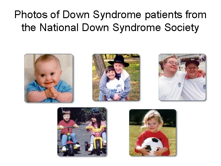 Photos of Down Syndrome patients from the National Down Syndrome Society Photos of Down Syndrome patients from the National Down Syndrome Society
