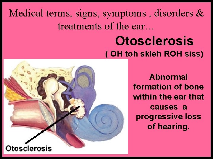 Medical terms, signs, symptoms , disorders & treatments of the ear… Otosclerosis ( OH