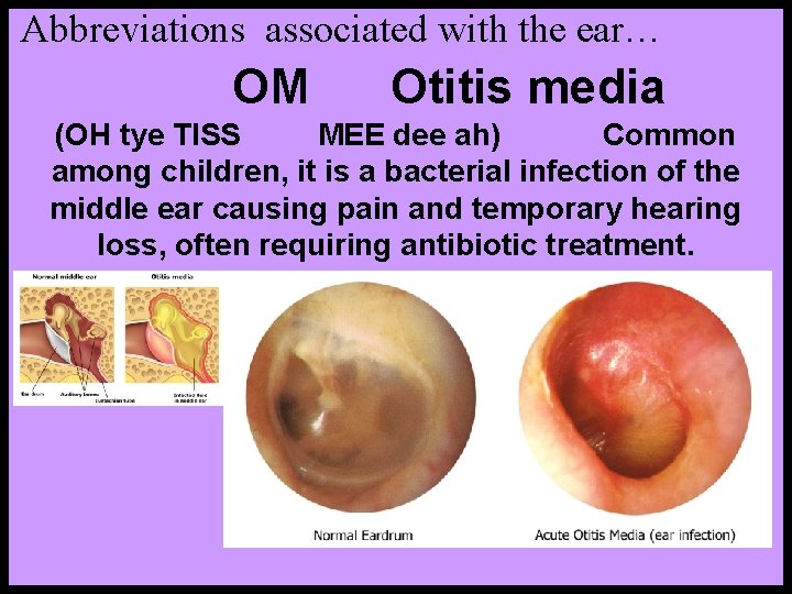 Abbreviations associated with the ear… OM Otitis media (OH tye TISS MEE dee ah)