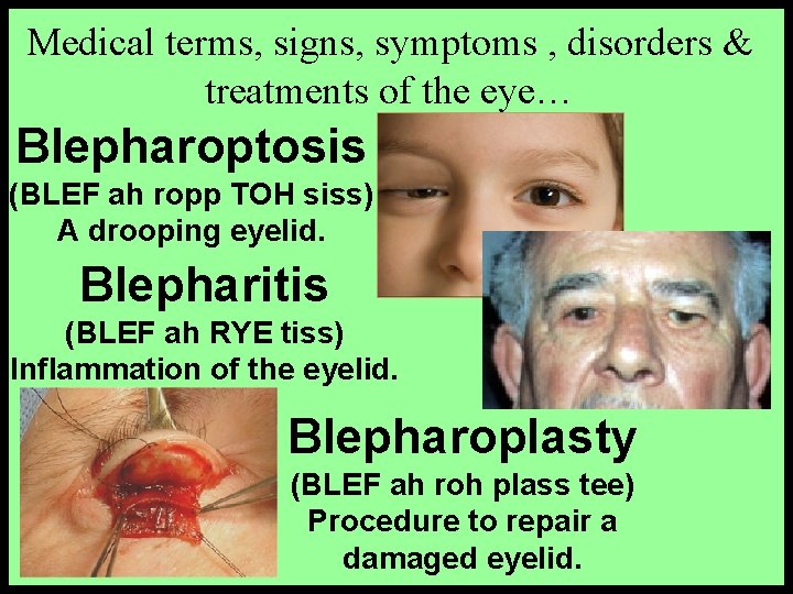 Medical terms, signs, symptoms , disorders & treatments of the eye… Blepharoptosis (BLEF ah