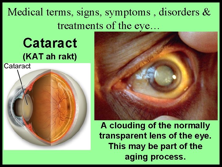Medical terms, signs, symptoms , disorders & treatments of the eye… Cataract (KAT ah