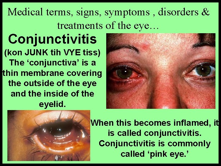 Medical terms, signs, symptoms , disorders & treatments of the eye… Conjunctivitis (kon JUNK
