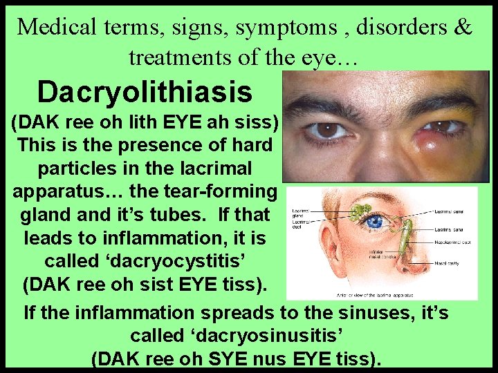 Medical terms, signs, symptoms , disorders & treatments of the eye… Dacryolithiasis (DAK ree