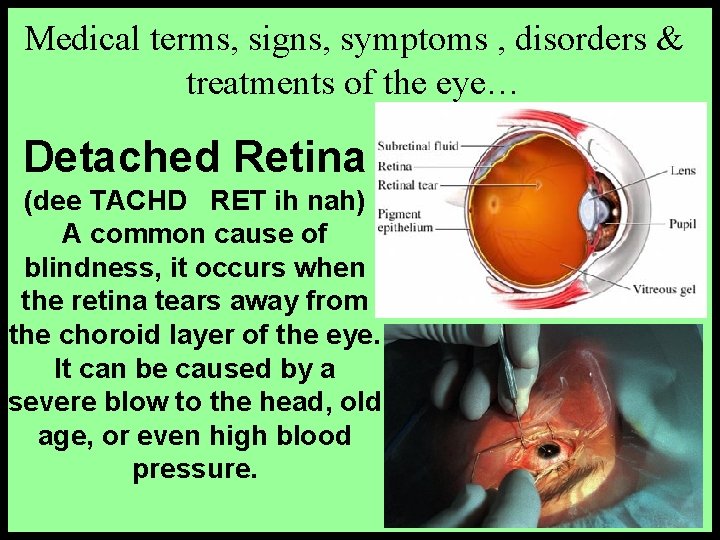 Medical terms, signs, symptoms , disorders & treatments of the eye… Detached Retina (dee