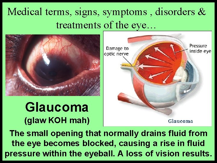 Medical terms, signs, symptoms , disorders & treatments of the eye… Glaucoma (glaw KOH