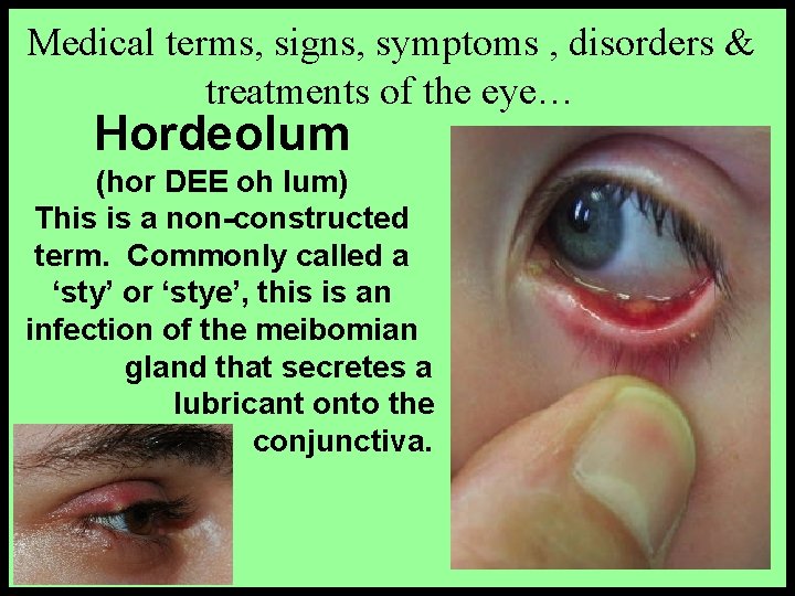 Medical terms, signs, symptoms , disorders & treatments of the eye… Hordeolum (hor DEE