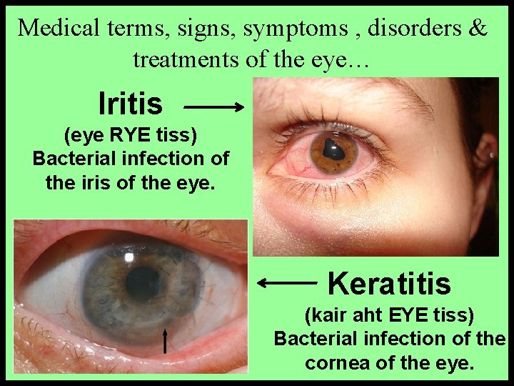 Medical terms, signs, symptoms , disorders & treatments of the eye… Iritis (eye RYE