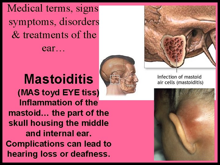 Medical terms, signs, symptoms, disorders & treatments of the ear… Mastoiditis (MAS toyd EYE
