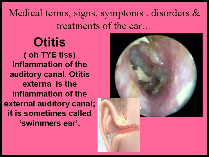 Medical terms, signs, symptoms , disorders & treatments of the ear… Otitis ( oh