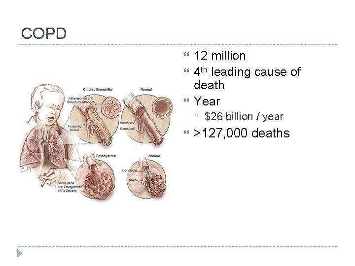 COPD 12 million 4 th leading cause of death Year $26 billion / year