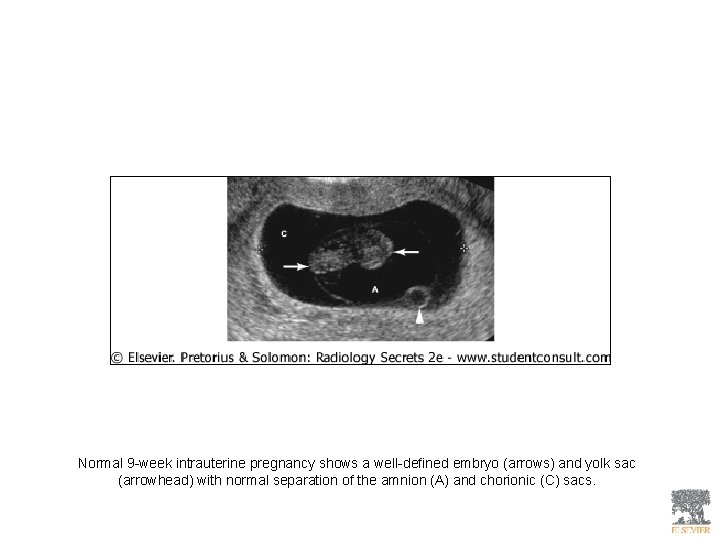 Normal 9 -week intrauterine pregnancy shows a well-defined embryo (arrows) and yolk sac (arrowhead)