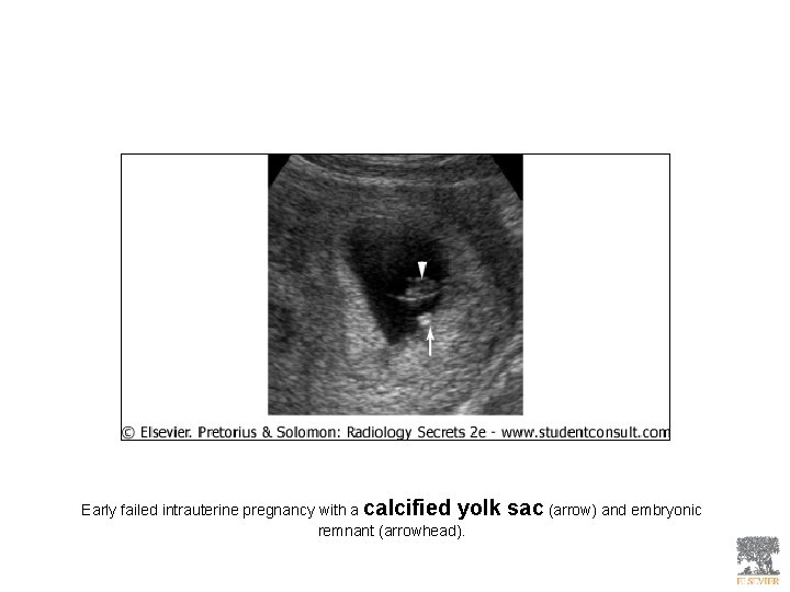 Early failed intrauterine pregnancy with a calcified yolk remnant (arrowhead). sac (arrow) and embryonic