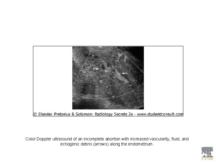 Color Doppler ultrasound of an incomplete abortion with increased vascularity, fluid, and echogenic debris