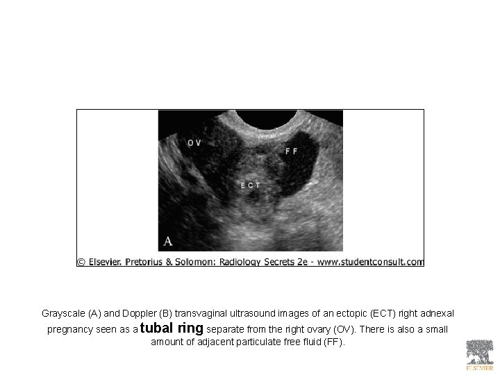Grayscale (A) and Doppler (B) transvaginal ultrasound images of an ectopic (ECT) right adnexal