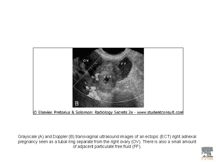 Grayscale (A) and Doppler (B) transvaginal ultrasound images of an ectopic (ECT) right adnexal