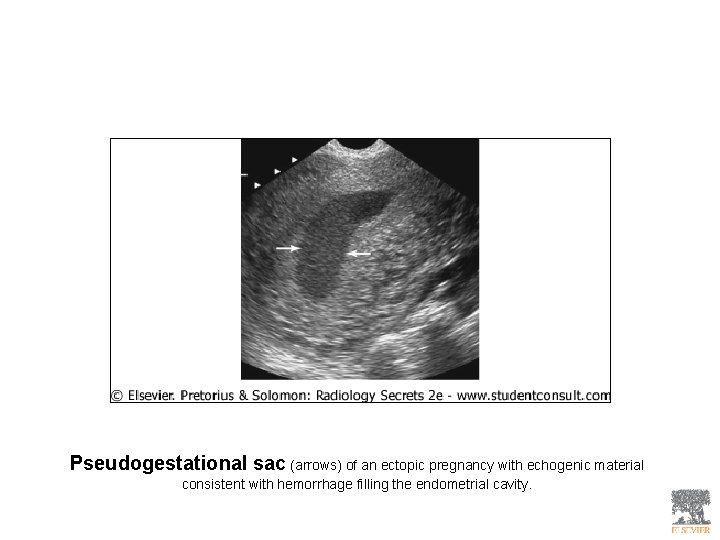 Pseudogestational sac (arrows) of an ectopic pregnancy with echogenic material consistent with hemorrhage filling