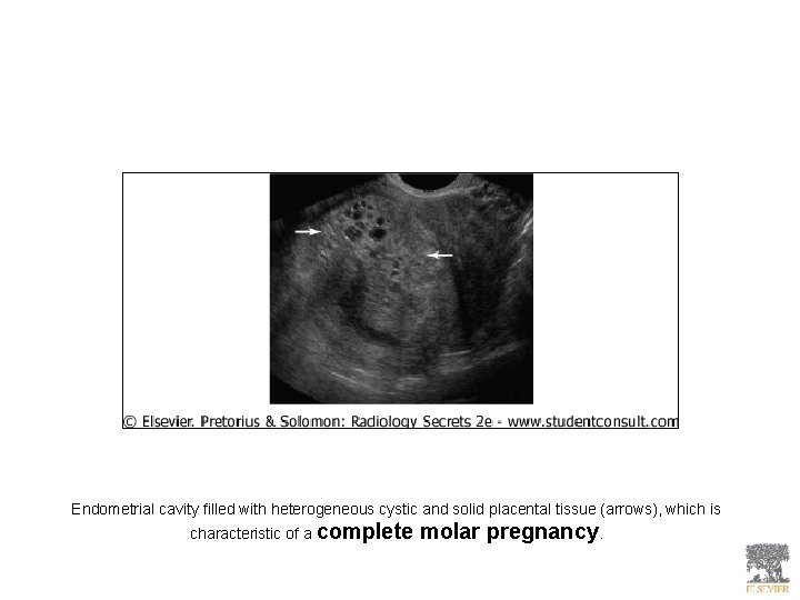 Endometrial cavity filled with heterogeneous cystic and solid placental tissue (arrows), which is characteristic