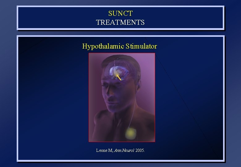 SUNCT TREATMENTS Hypothalamic Stimulator Leone M, Ann Neurol 2005. 