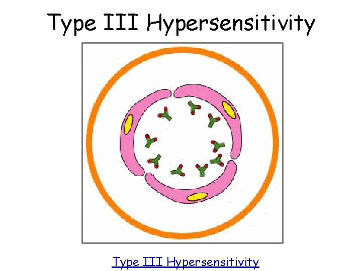 Type III Hypersensitivity 