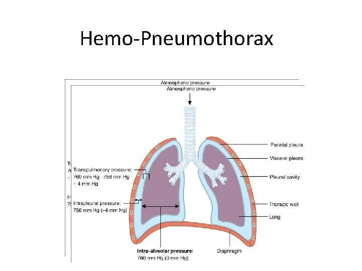 Hemo-Pneumothorax 