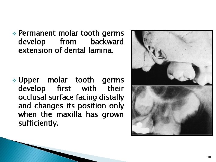 v v Permanent molar tooth germs develop from backward extension of dental lamina. Upper