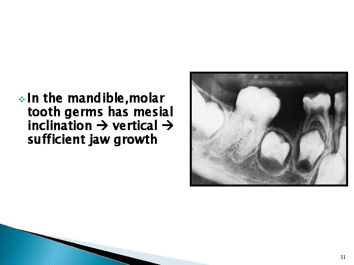 v In the mandible, molar tooth germs has mesial inclination vertical sufficient jaw growth