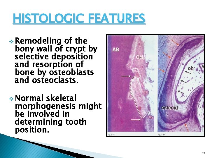 HISTOLOGIC FEATURES v Remodeling of the bony wall of crypt by selective deposition and