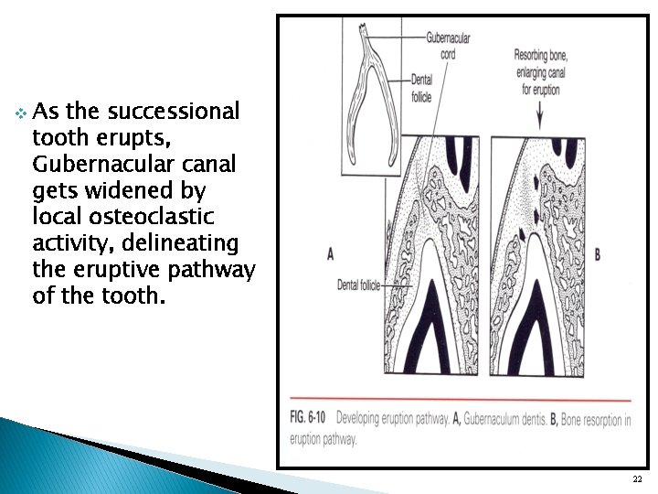 v As the successional tooth erupts, Gubernacular canal gets widened by local osteoclastic activity,
