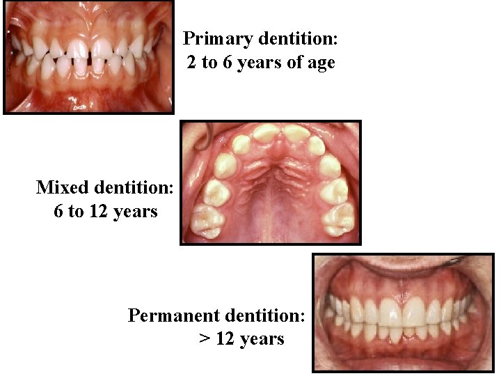 Primary dentition: 2 to 6 years of age Mixed dentition: 6 to 12 years