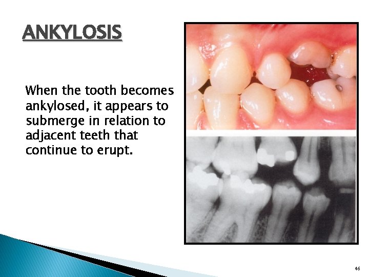 ANKYLOSIS When the tooth becomes ankylosed, it appears to submerge in relation to adjacent