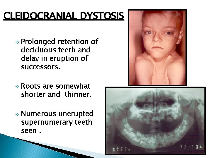 CLEIDOCRANIAL DYSTOSIS v v v Prolonged retention of deciduous teeth and delay in eruption