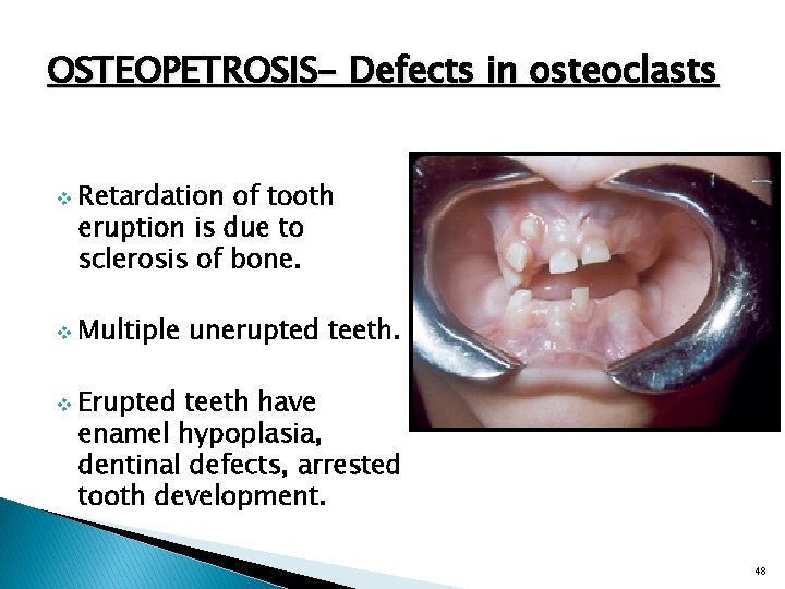 OSTEOPETROSIS- Defects in osteoclasts v v v Retardation of tooth eruption is due to