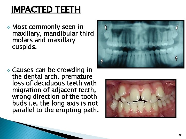 IMPACTED TEETH v v Most commonly seen in maxillary, mandibular third molars and maxillary