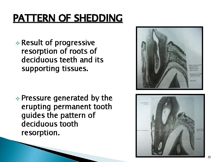 PATTERN OF SHEDDING v v Result of progressive resorption of roots of deciduous teeth