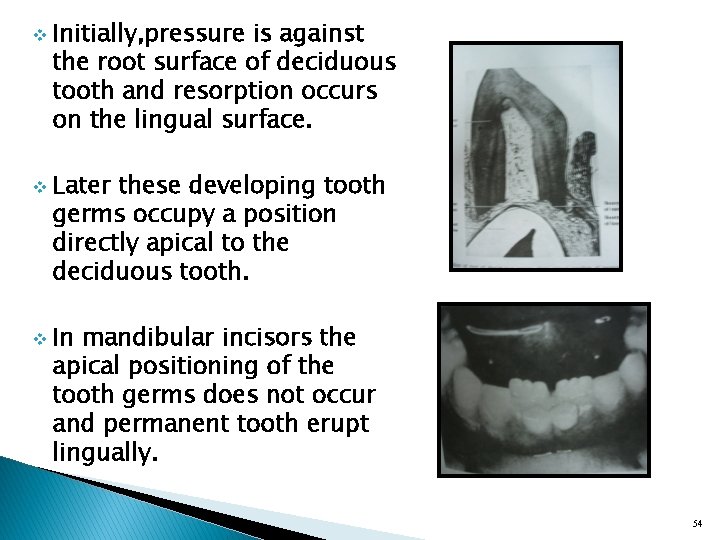 v v v Initially, pressure is against the root surface of deciduous tooth and