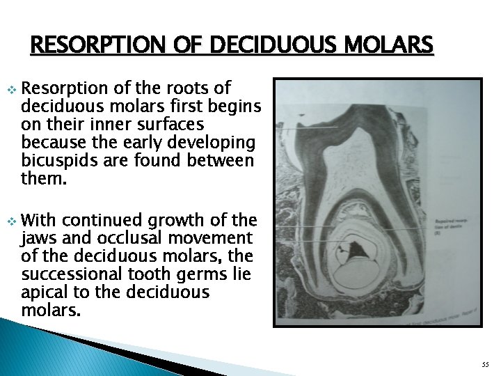 RESORPTION OF DECIDUOUS MOLARS v v Resorption of the roots of deciduous molars first