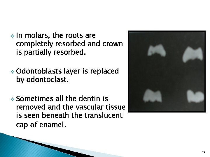 v v v In molars, the roots are completely resorbed and crown is partially