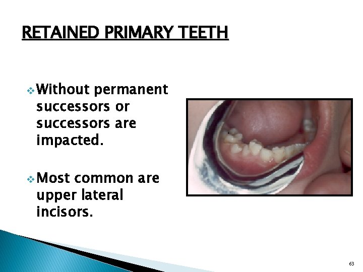 RETAINED PRIMARY TEETH v Without permanent successors or successors are impacted. v Most common