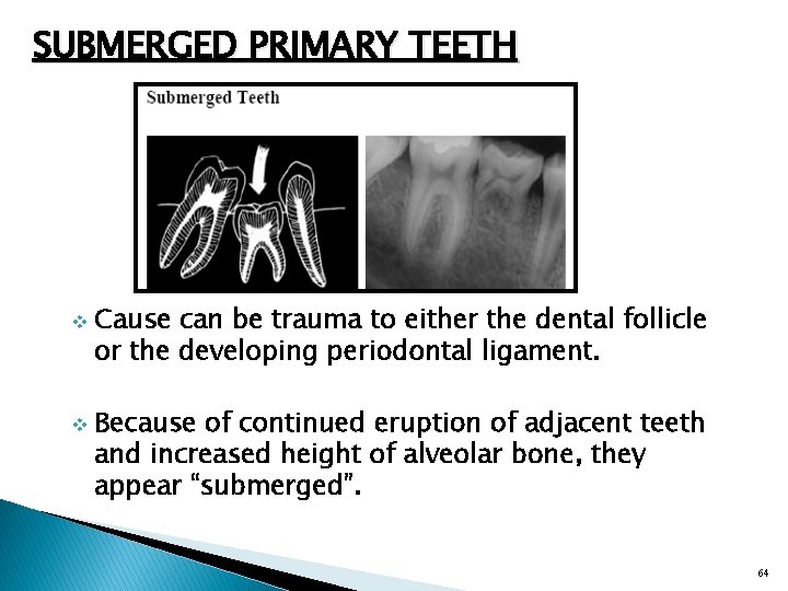 SUBMERGED PRIMARY TEETH v v Cause can be trauma to either the dental follicle