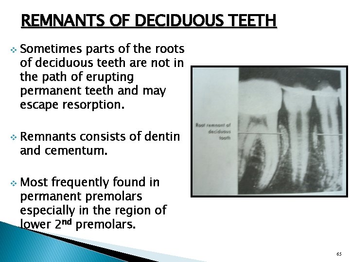 REMNANTS OF DECIDUOUS TEETH v v v Sometimes parts of the roots of deciduous