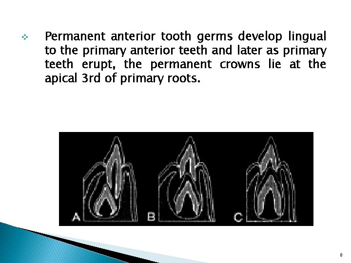 v Permanent anterior tooth germs develop lingual to the primary anterior teeth and later