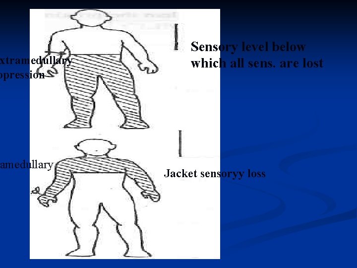 xtramedullary opression amedullary Sensory level below which all sens. are lost Jacket sensoryy loss