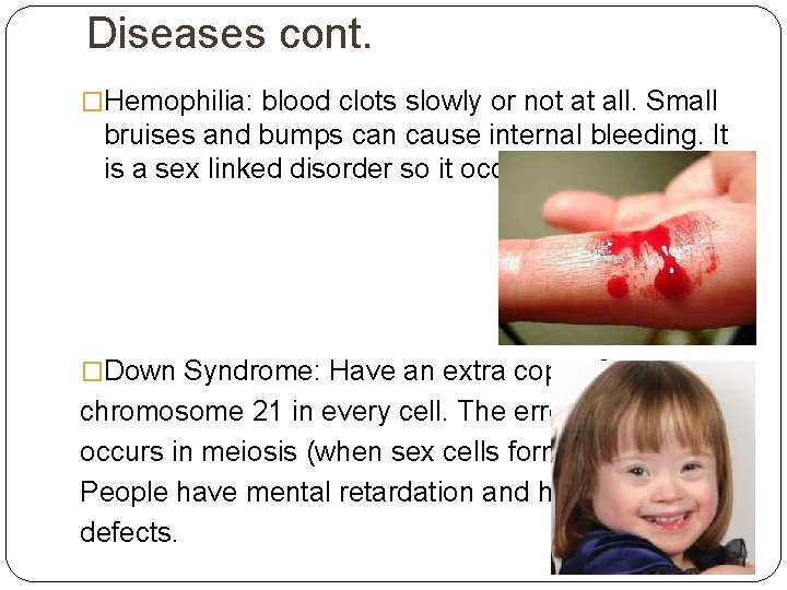 Diseases cont. �Hemophilia: blood clots slowly or not at all. Small bruises and bumps