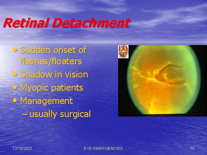 Retinal Detachment • Sudden onset of flashes/floaters • Shadow in vision • Myopic patients