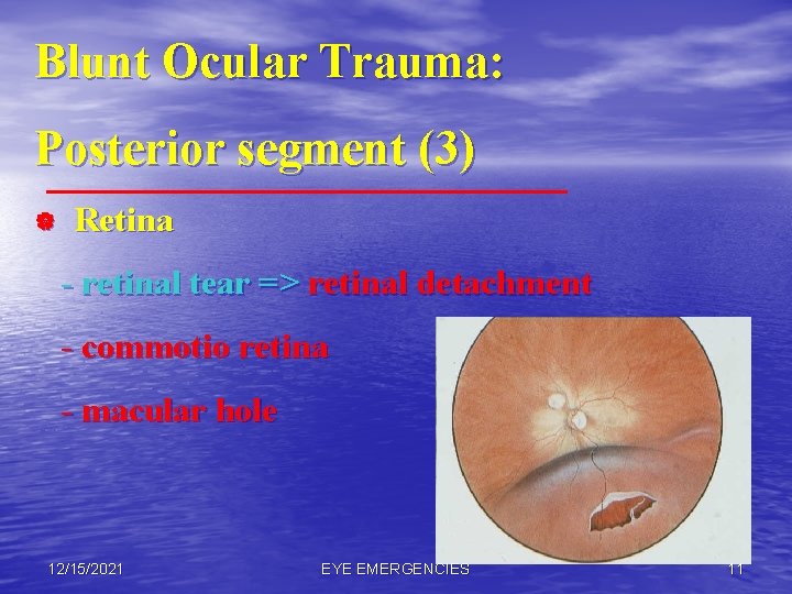 Blunt Ocular Trauma: Posterior segment (3) | Retina - retinal tear => retinal detachment