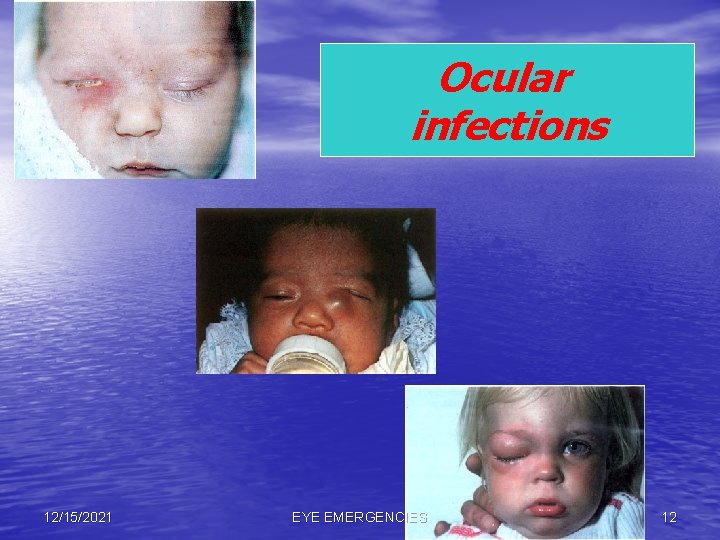 Ocular infections 12/15/2021 EYE EMERGENCIES 12 
