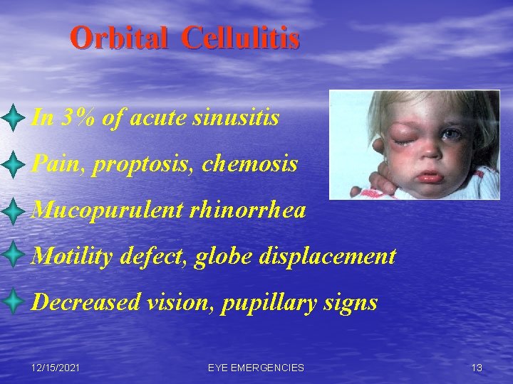 Orbital Cellulitis In 3% of acute sinusitis Pain, proptosis, chemosis Mucopurulent rhinorrhea Motility defect,