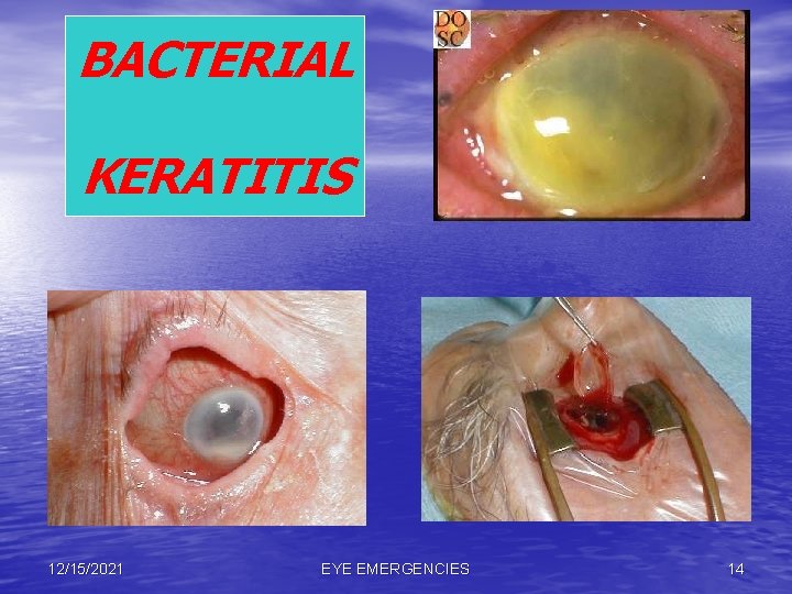 BACTERIAL KERATITIS 12/15/2021 EYE EMERGENCIES 14 