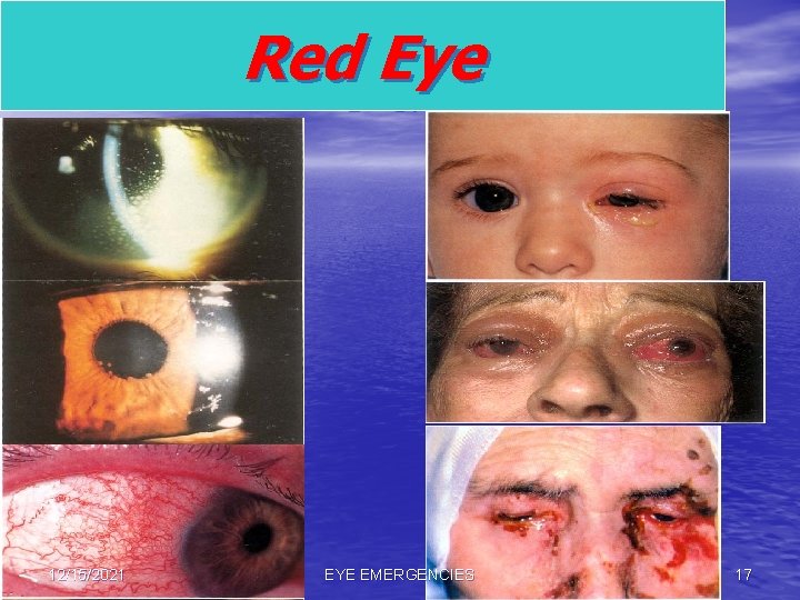 Red Eye 12/15/2021 EYE EMERGENCIES 17 